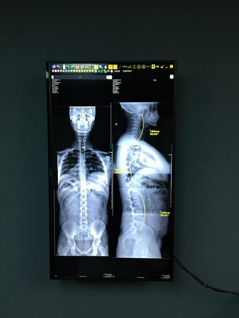 Cervical Facet Syndrome