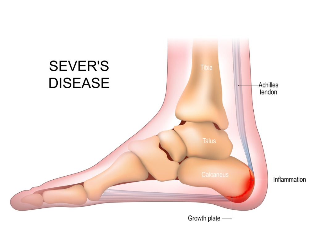 Severs Disease image
